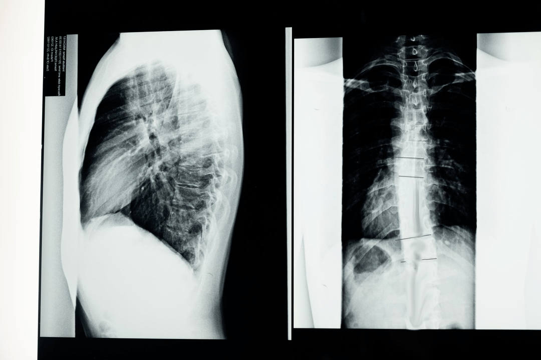 osteocondroza din partea stângă