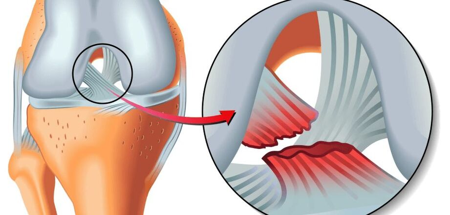 articulația genunchiului rănită