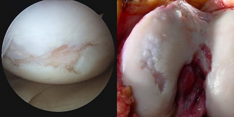 deteriorarea articulației genunchiului este vizibilă în timpul operației