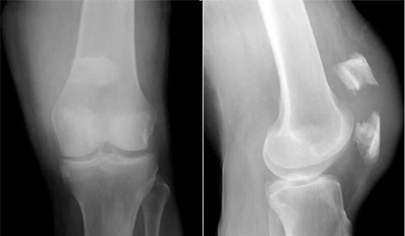 radiografia genunchiului