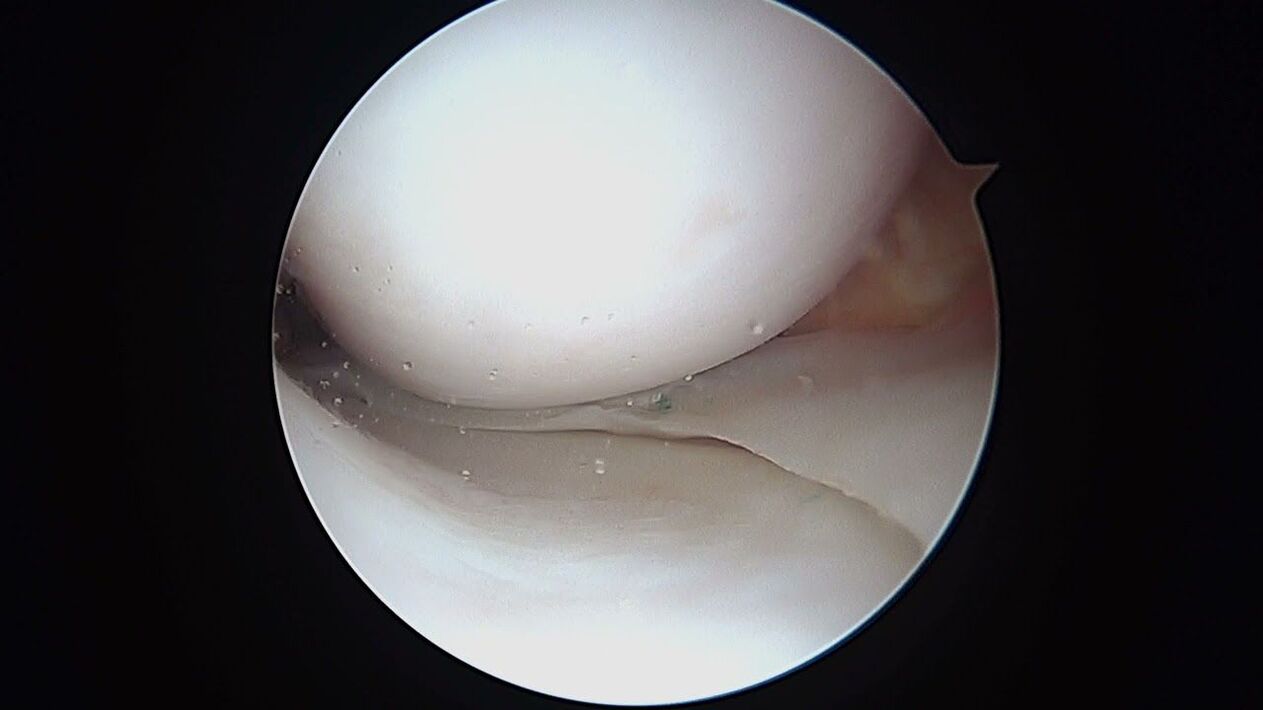 vedere a articulației genunchiului prin artroscop