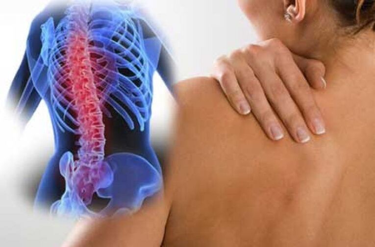 Cu osteocondroză, durerea poate radia către părți îndepărtate ale corpului
