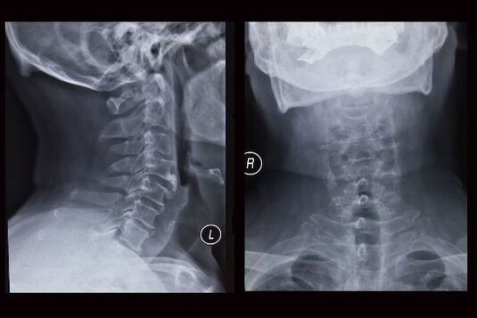 Imagine cu raze X a coloanei cervicale (pacientul are osteocondroză)