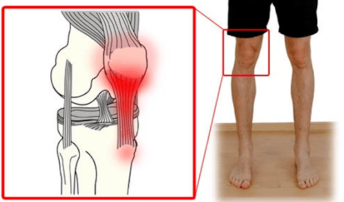 Tendinita este o inflamație a țesutului tendonului care provoacă durere în articulația genunchiului. 