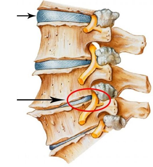 Osteochondroza cervicală