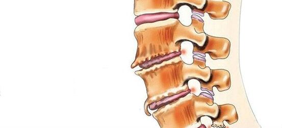 Spondiloza - Distrugerea articulațiilor intervertebrale
