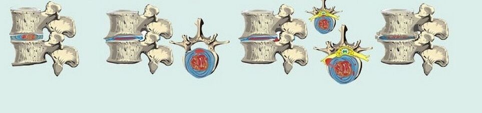 Diverse etape ale osteochondrozei toracice