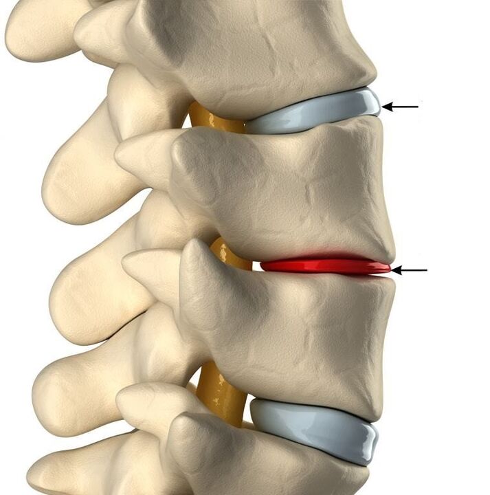 diferența dintre un disc sănătos și un disc cu osteochondroză