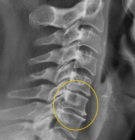osteocondroza cervicală