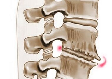 afectarea vertebrelor în osteocondroza toracică
