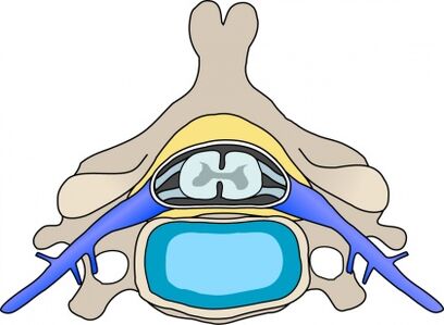 proeminență în vertebră cu osteocondroză cervicală