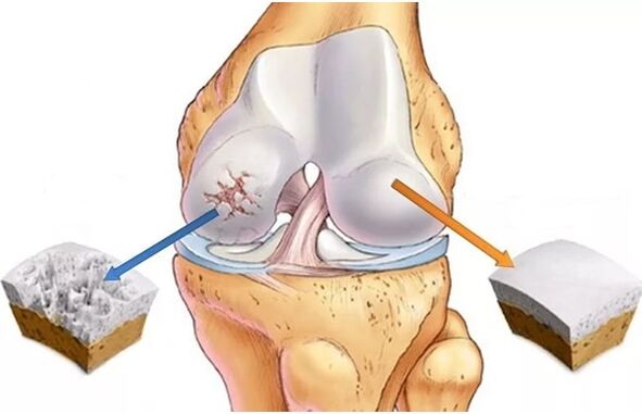 cartilaj sănătos și cartilaj afectat de artroză