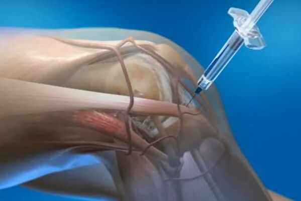 injecții intraarticulare pentru artroza articulației genunchiului